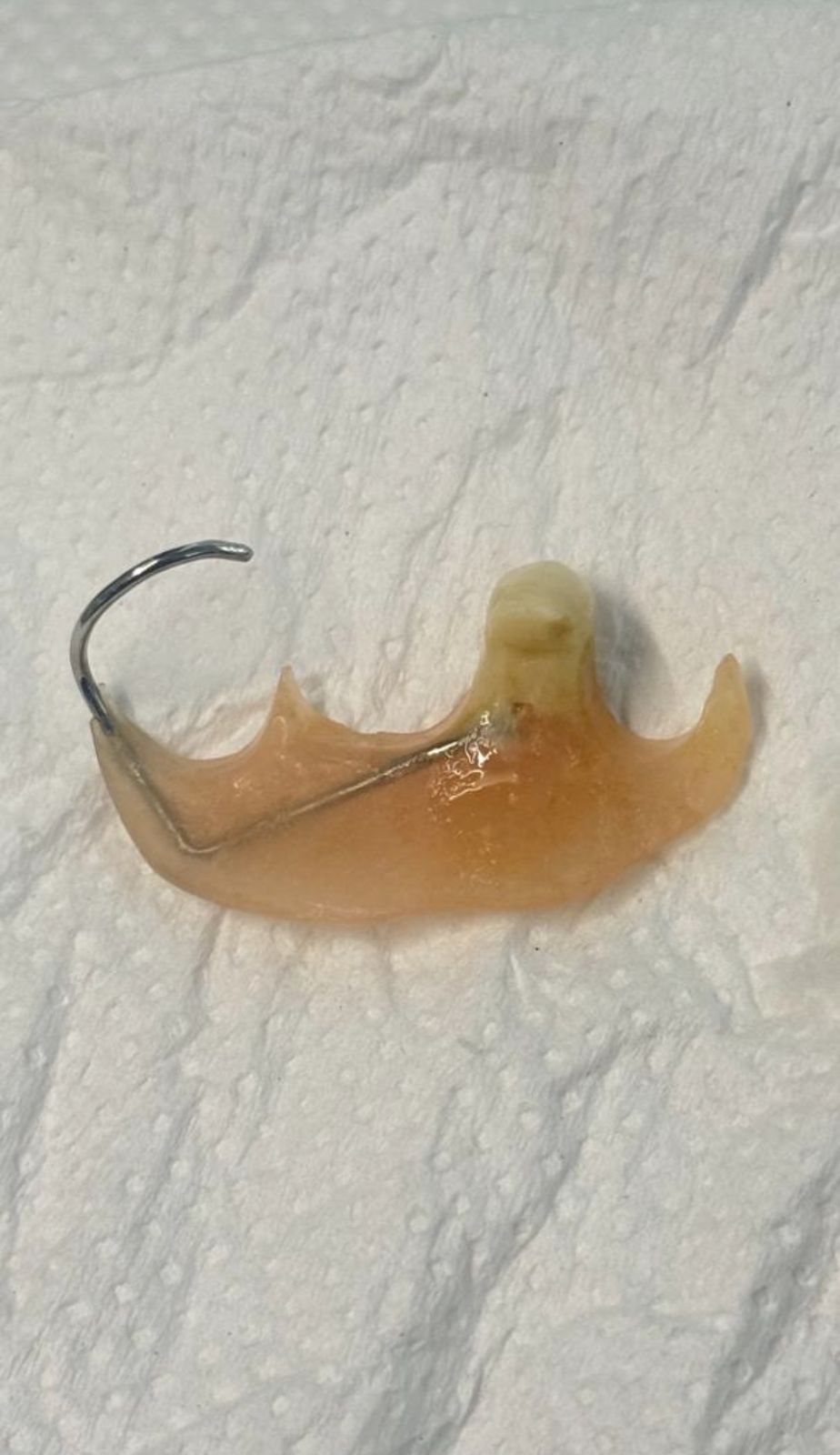 Prótesis dental con gancho metálico extraída por endoscopia, sobre una gasa