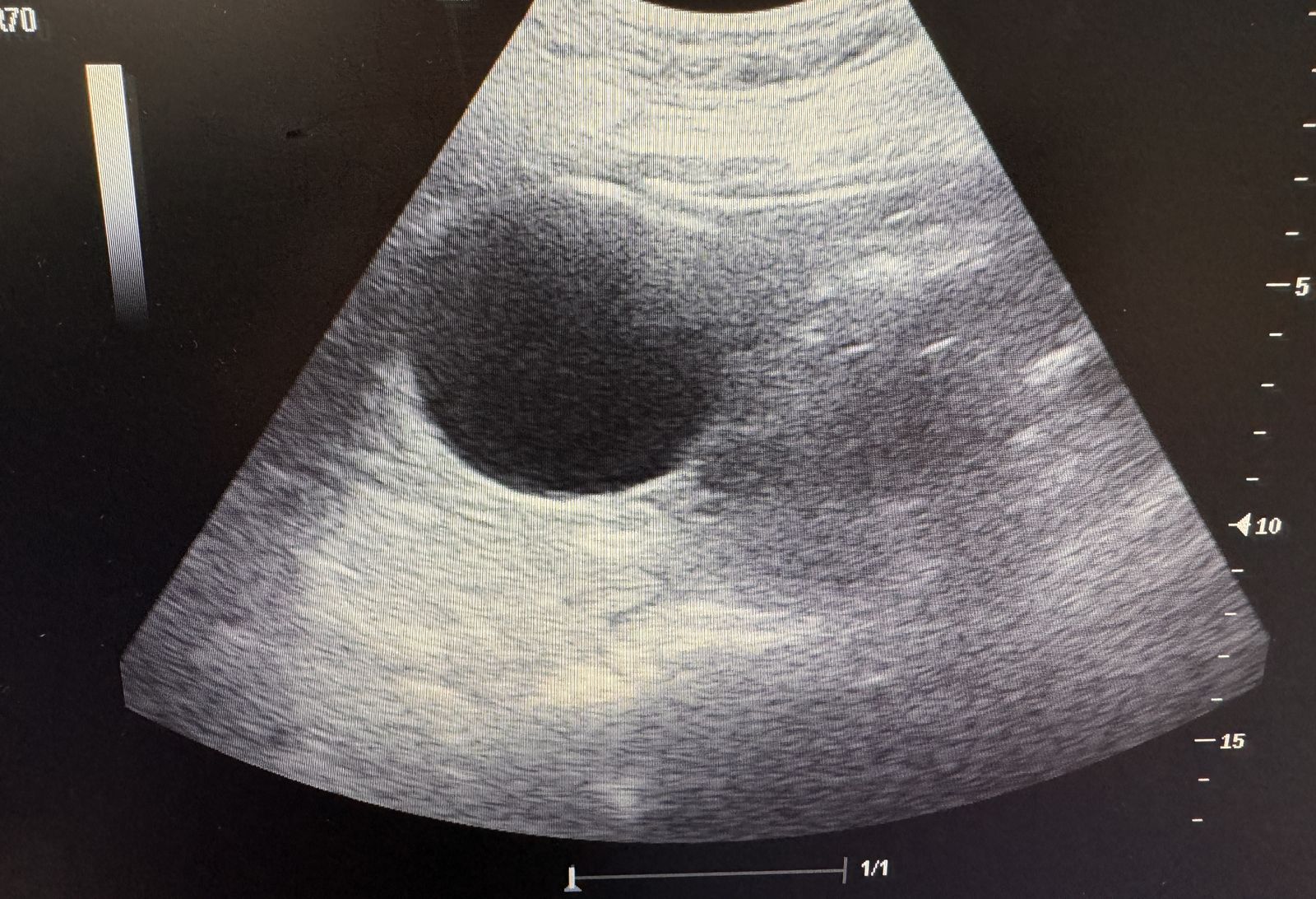 Imagen de ecografía abdominal con una estructura llena de líquido