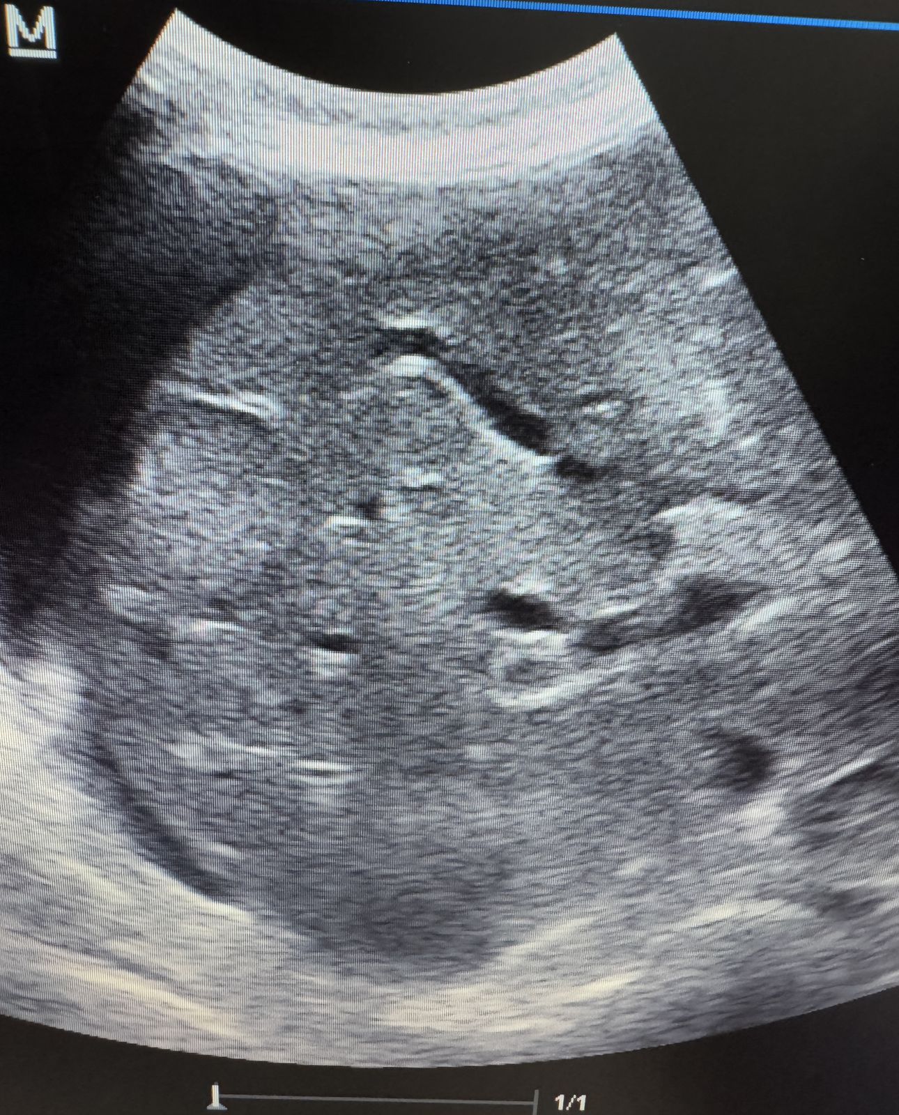 Imagen de ecografía abdominal del hígado