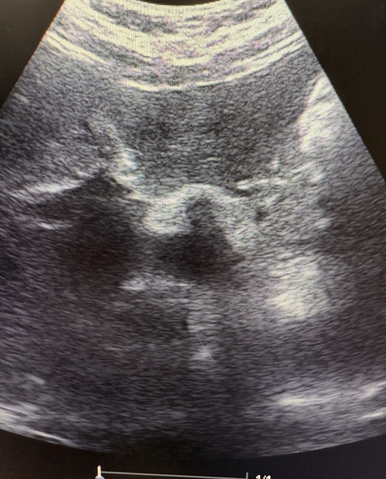 Imagen de ecografía abdominal en el monitor
