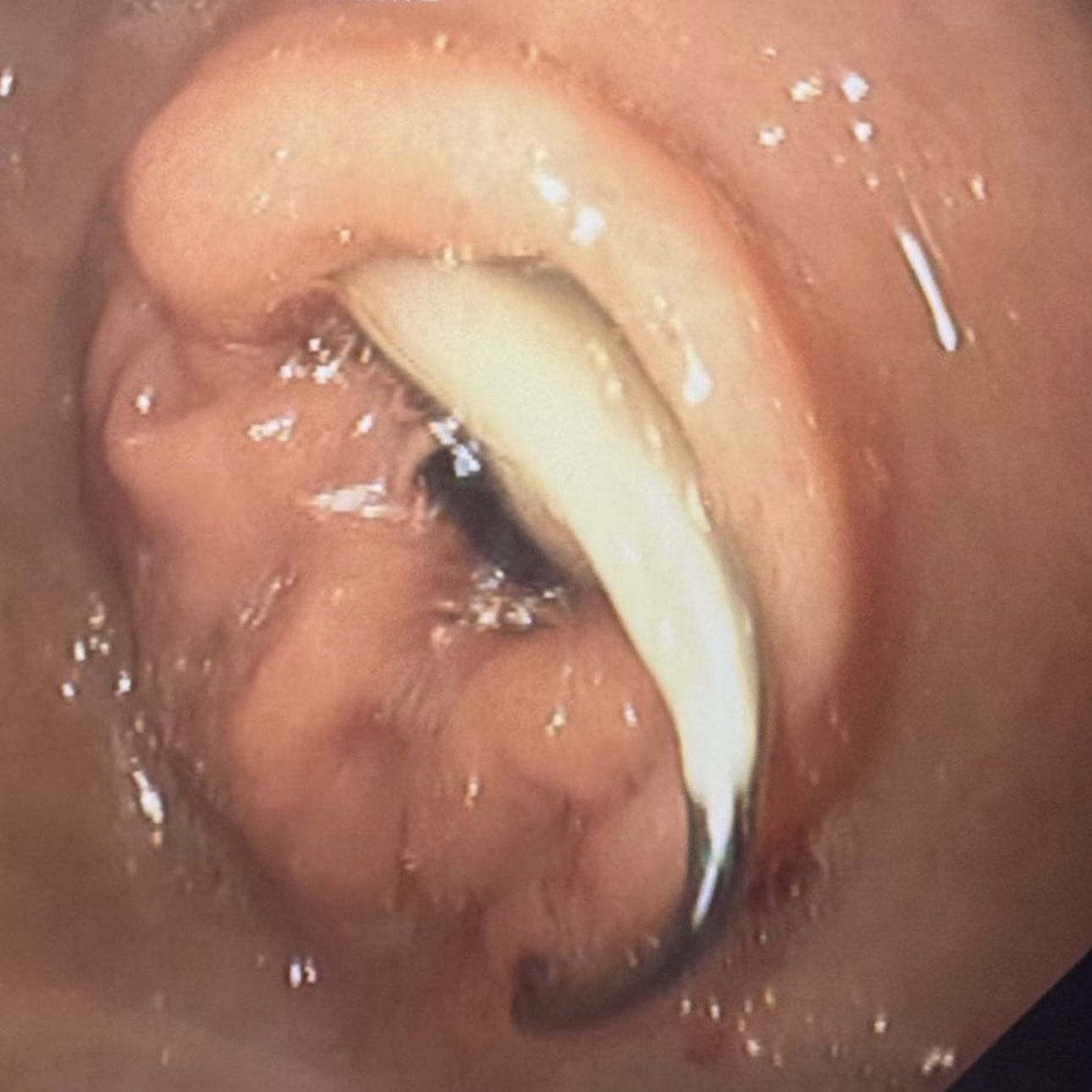 Vista endoscópica de una prótesis dental atrapada en el tubo digestivo