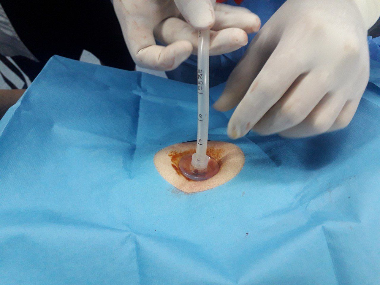 Paso de la sonda de gastrostomía a través de la pared abdominal sobre un campo estéril