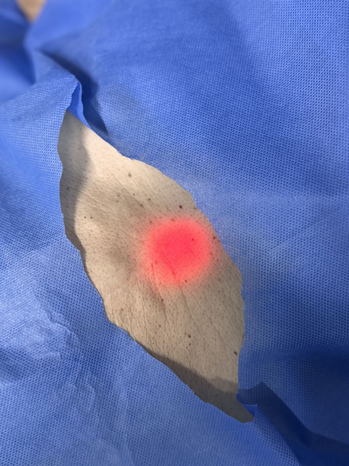 Luz del endoscopio visible a través de la pared abdominal para marcar el punto de la gastrostomía
