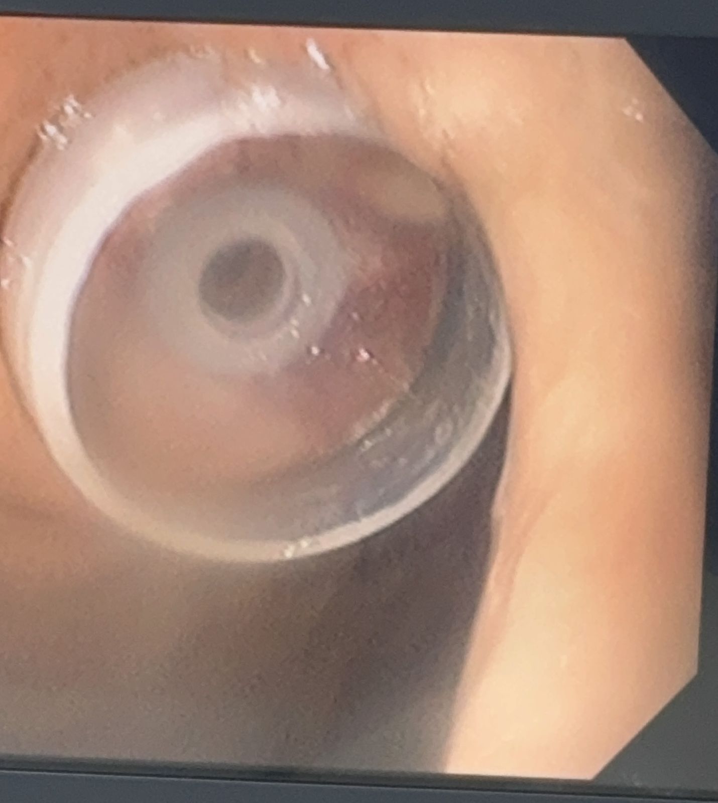 Vista endoscópica del soporte interno de la sonda de gastrostomía dentro del estómago