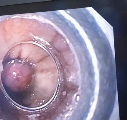 Vista endoscópica de una variz esofágica cerrada con una banda elástica