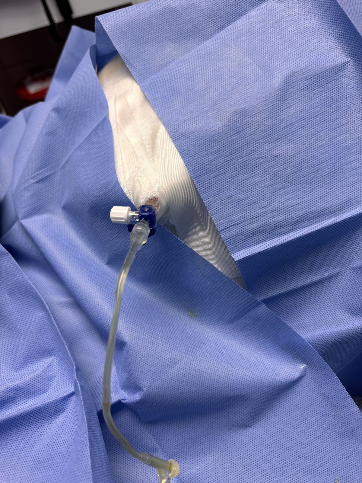 Catéter de paracentesis colocado bajo campo estéril