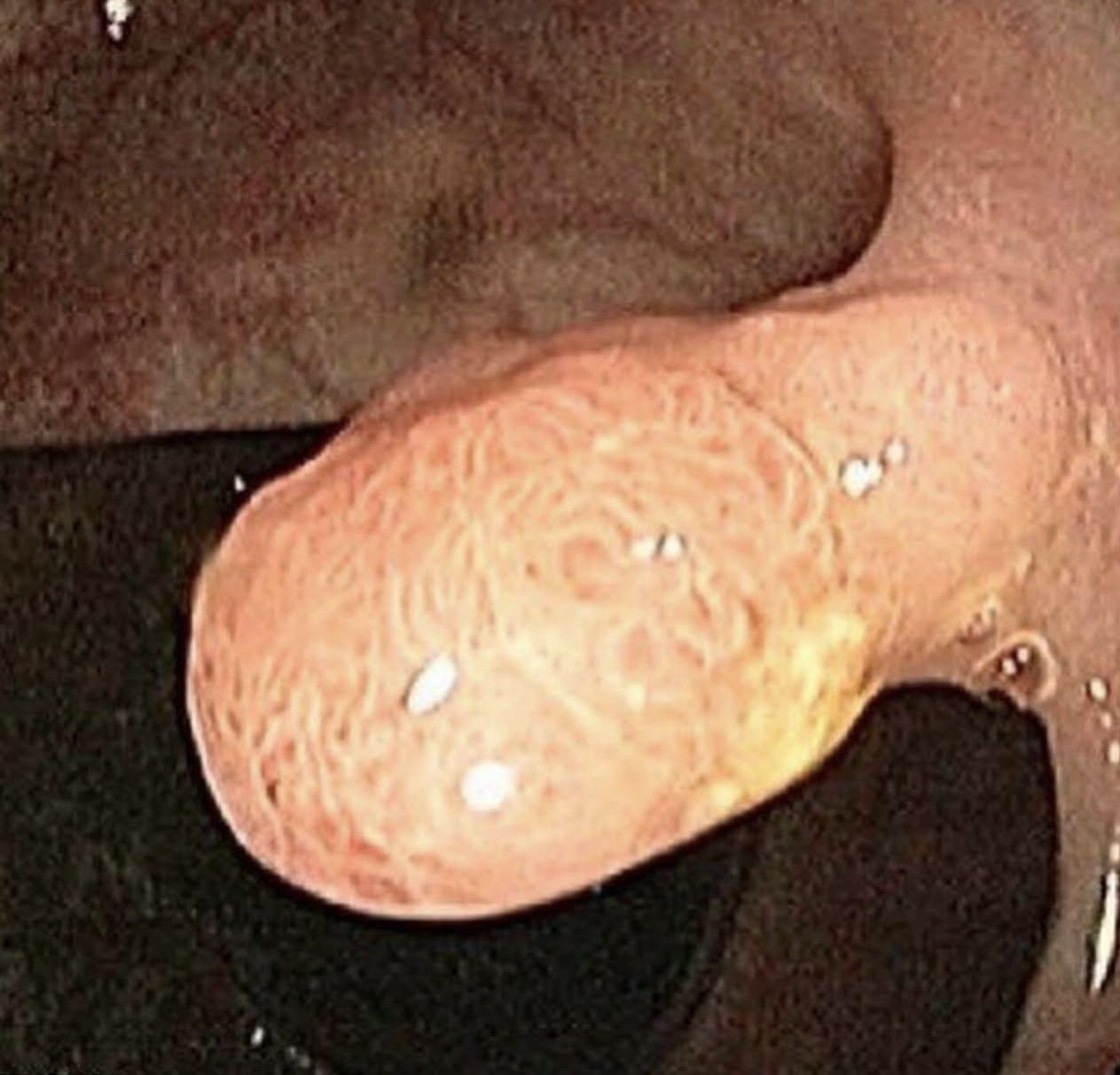 Imagen endoscópica de un pólipo en el colon