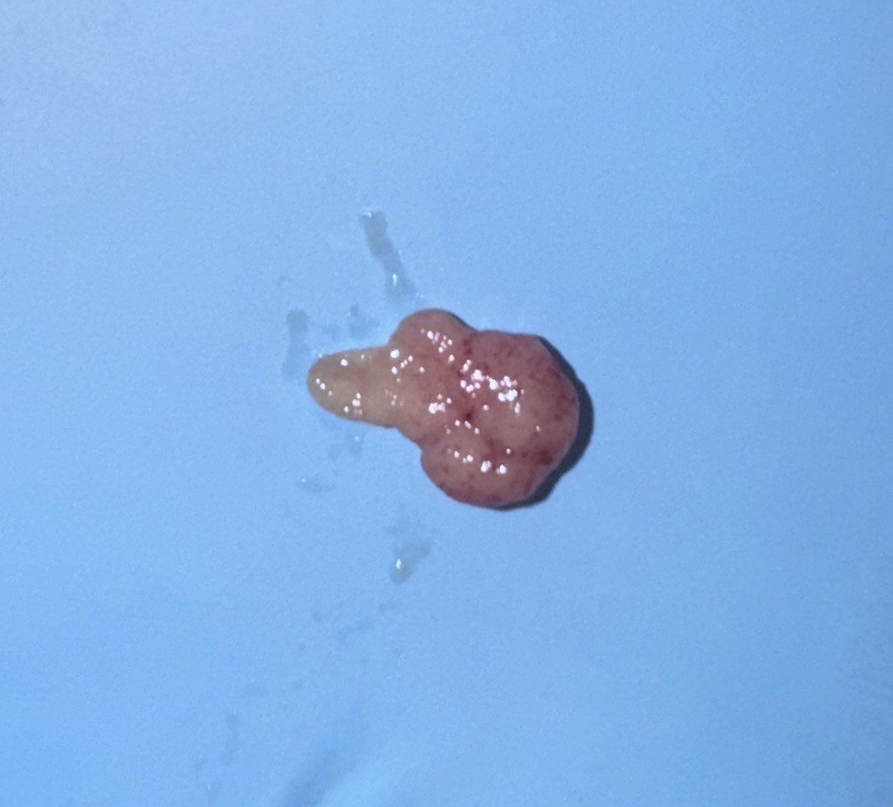 Pólipo ya extraído sobre una superficie azul, listo para enviarlo a anatomía patológica