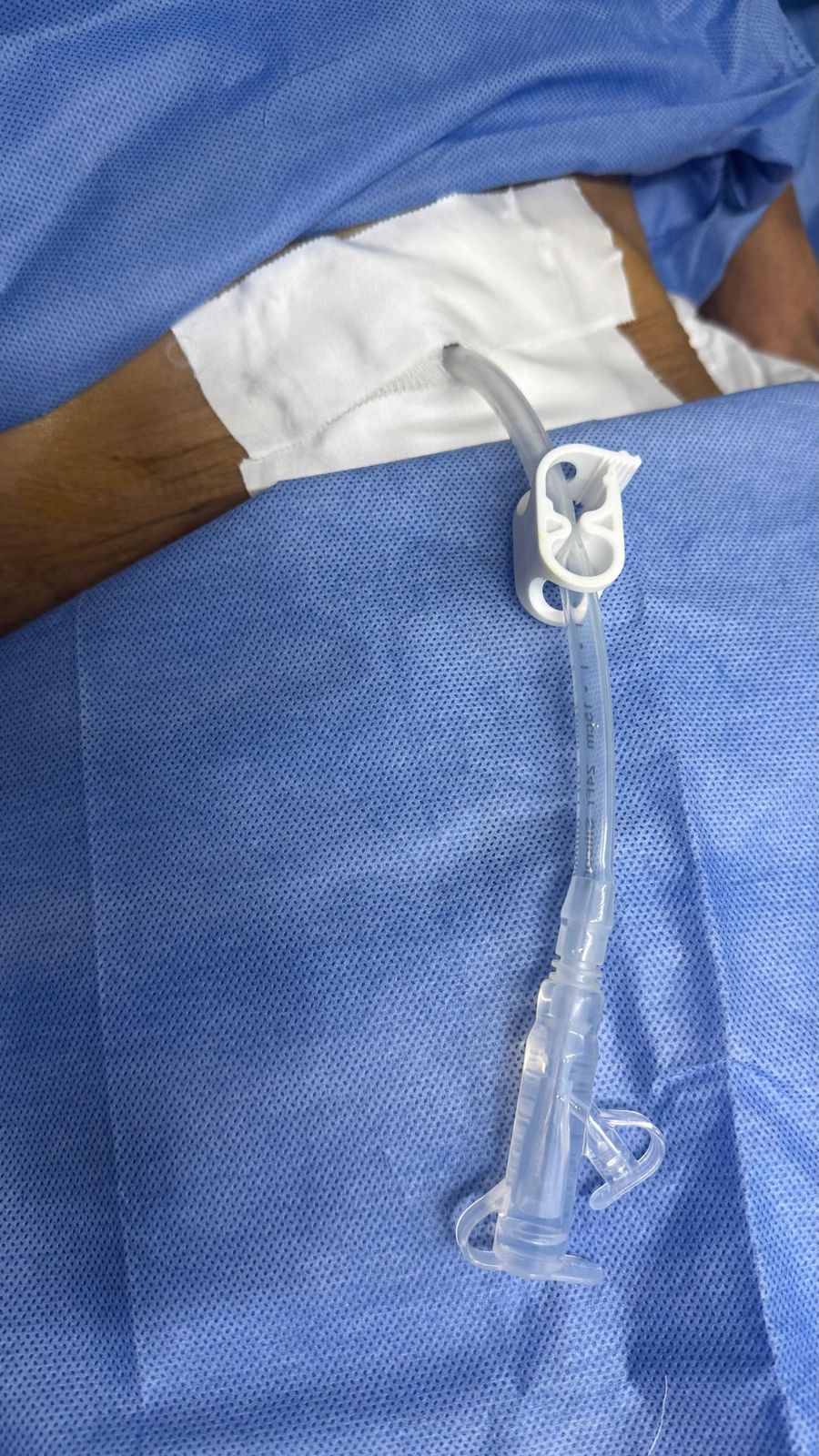 Sonda de gastrostomía ya colocada en el abdomen, sobre campo quirúrgico