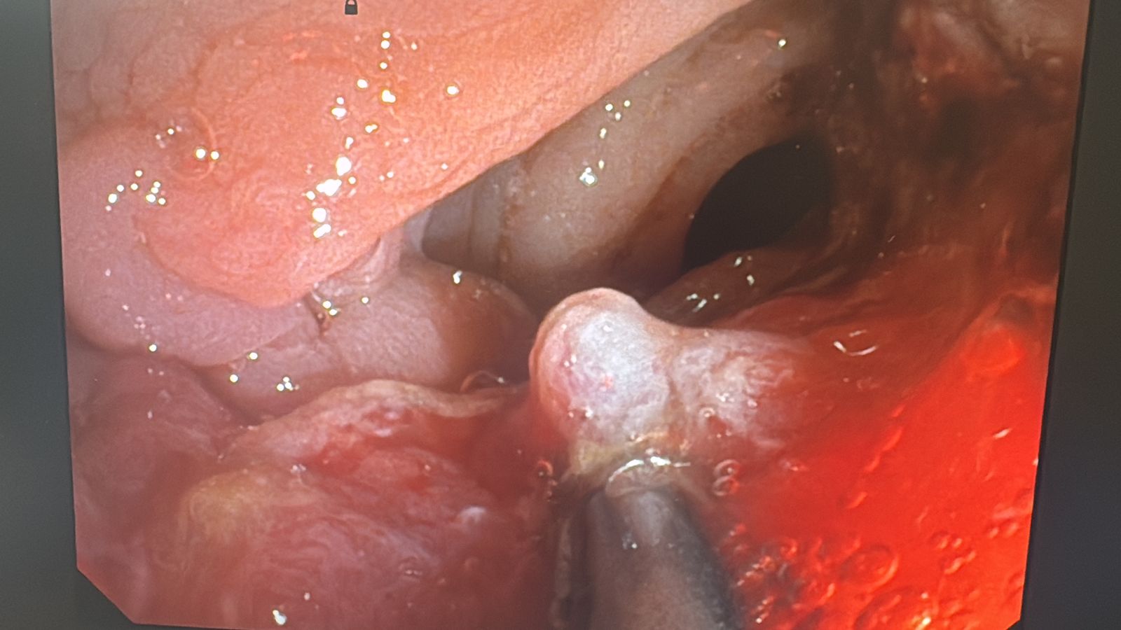 Imagen endoscópica de la pinza de biopsia tomando una muestra de la mucosa
